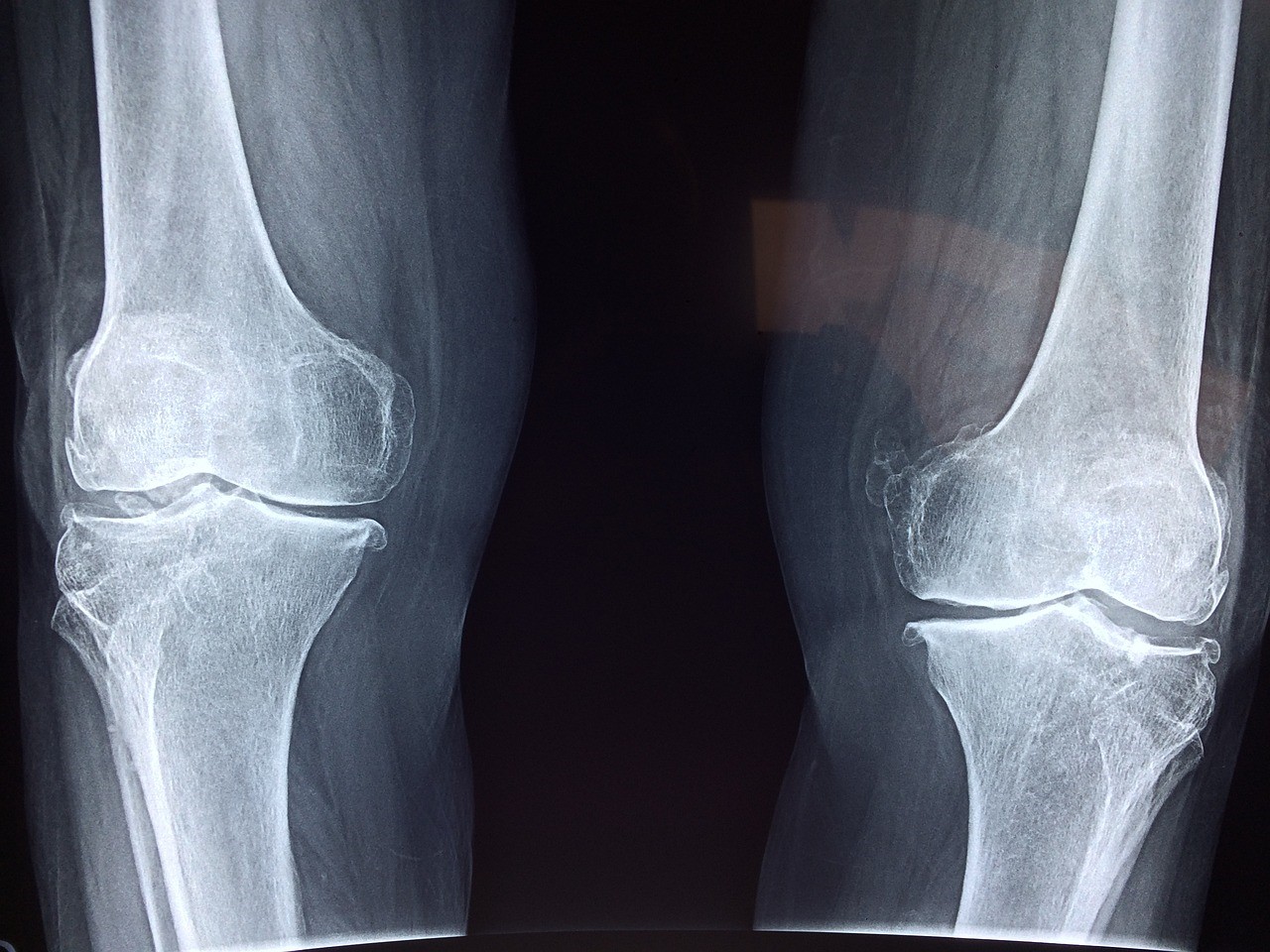骨細胞の老化に関する新知見を公開(No Bones About It: New Details About Skeletal Cell Aging Revealed)